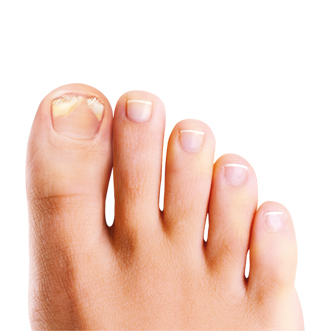ongles abimes pied ongles abimes pied
